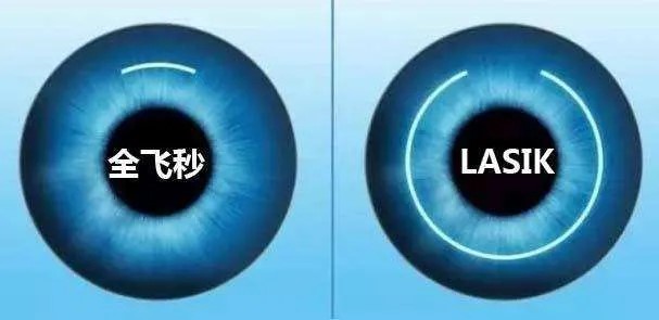 为什么广州视百年眼科医院可以不用做散瞳？