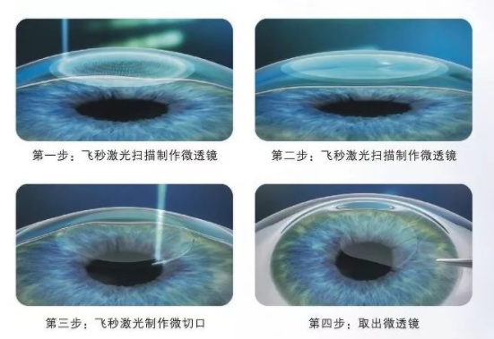 全飞秒激光手术矫正视力的原理是什么?